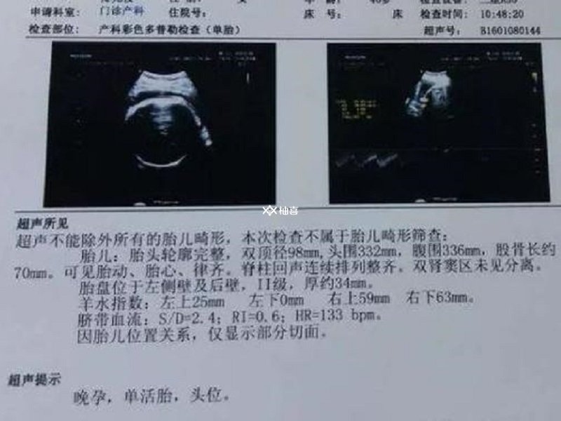 B超单上bpd减去fl结果小于2不一定是女孩