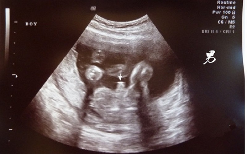 孕囊椭圆形竟然是男孩图片
