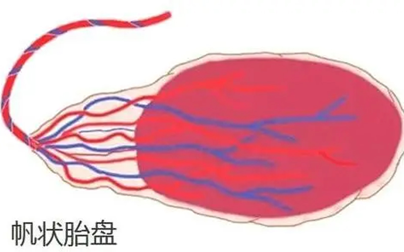 帆状胎盘前置血管图片