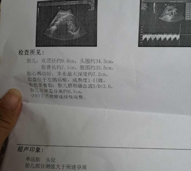 胎儿彩超检查报告单