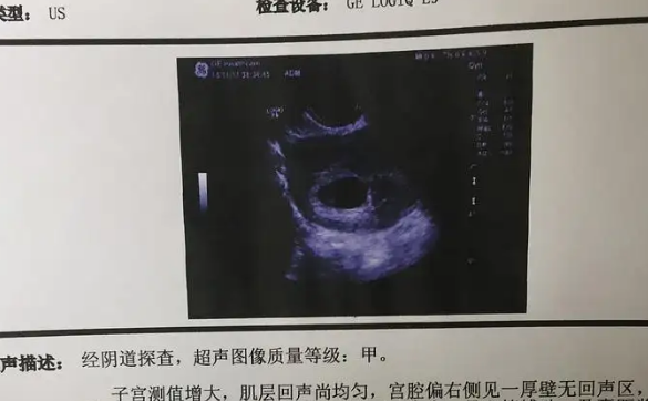 孕妇去医院检查出孕囊偏右侧宫角