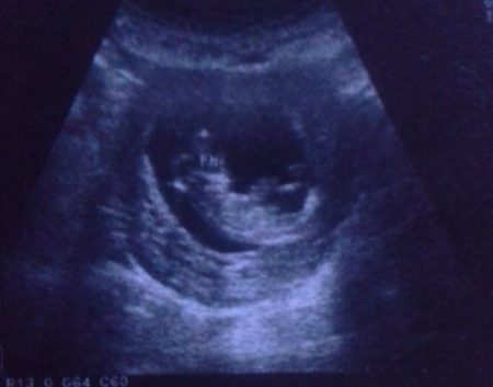 胎儿12周看不出性别